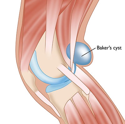 Bakerova cysta